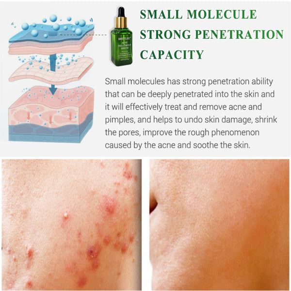 Facial Essence Anti Acne Scar Removal Cream Acne Treatment  Face Skin Care Whitening Repair Pimple Remover For blackhead Acne