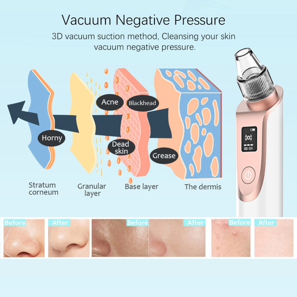 ANLAN Blackhead/Acne Pore Remover Vacuum Cleaner Extractor Comedones Removal -Facial Skin Care Tools